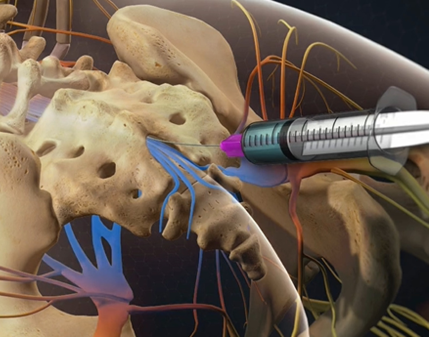 back-pain-after-epidural-causes-and-treatments-aica-orthopedics