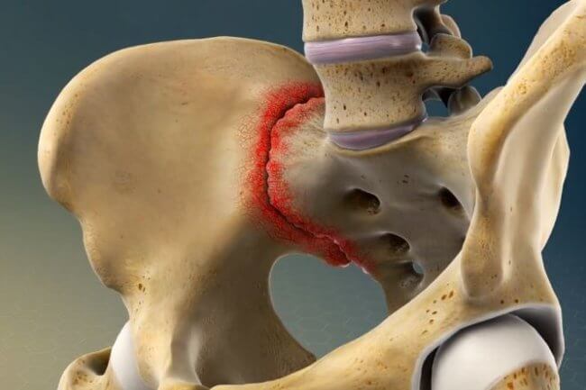 Illustrated x-ray graphic of sacroiliac joint glowing red to indicate pain