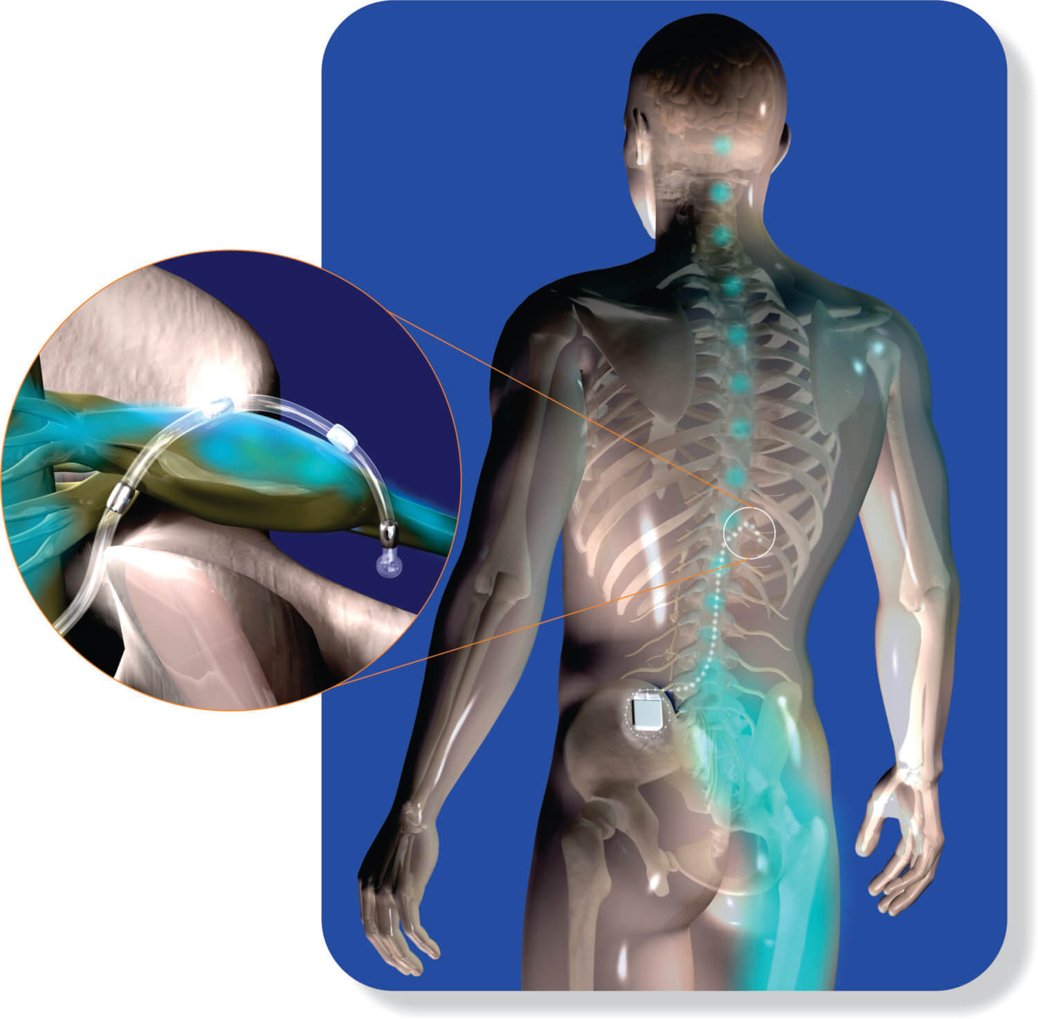 See-through image of a human body with a dorsal root ganglion (DRG) stimulator device implanted, along with a magnified view of the device lead resting next to a DRG in the spine