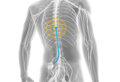 Spinal Cord Stimulation