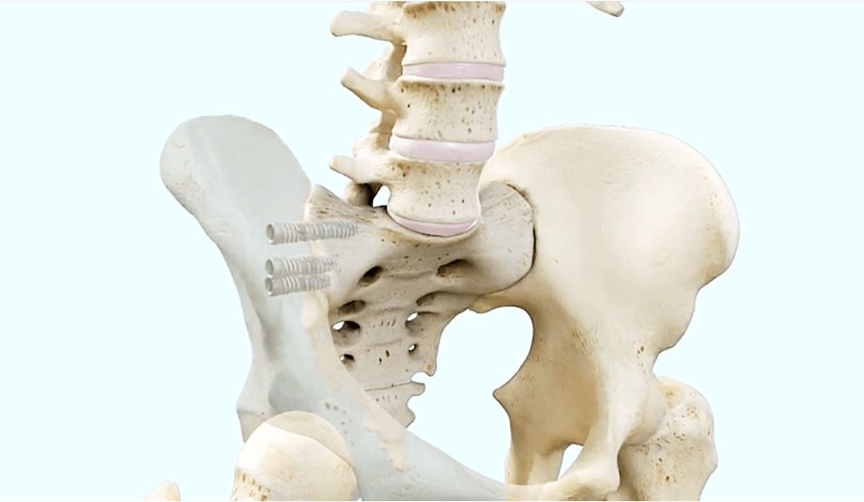Human hip and lower spine with the iFuse SI-Bone sacroiliac joint fusion system implanted
