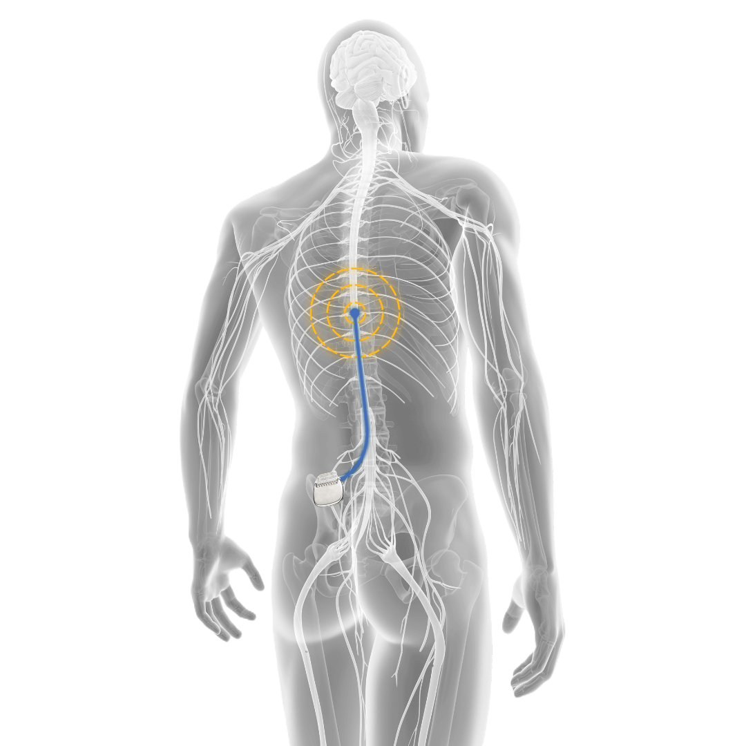 X Ray image of human body with SCS device implanted
