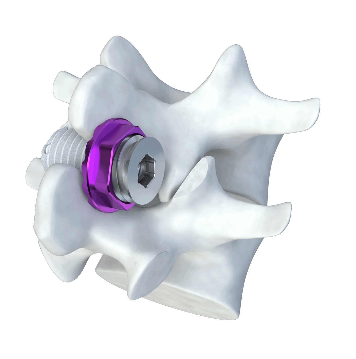 Illustration of the Minuteman fusion device implanted between two vertebrae bones