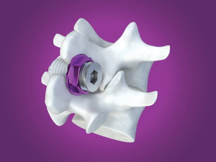 Illustrated image of implanted Minuteman device against a magenta background