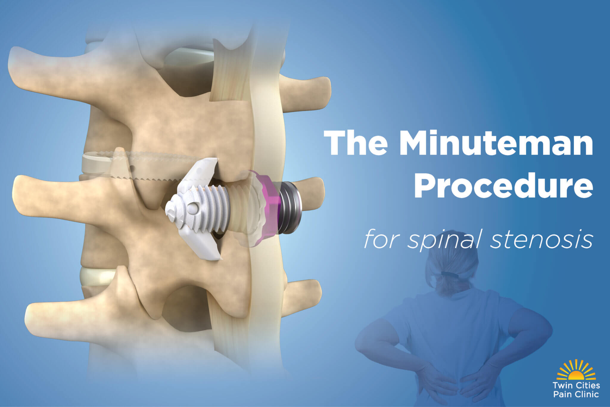 The Minuteman® Procedure for Spinal Stenosis