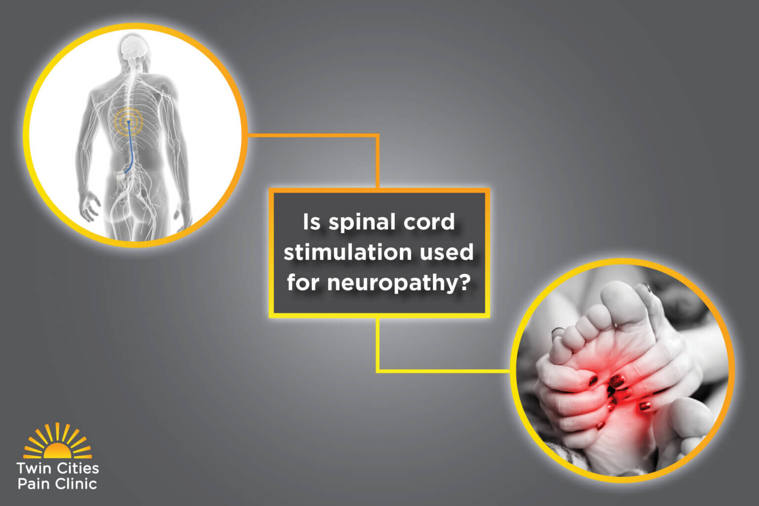 Is Spinal Cord Stimulation Used for Neuropathy? | Twin Cities Pain Clinic