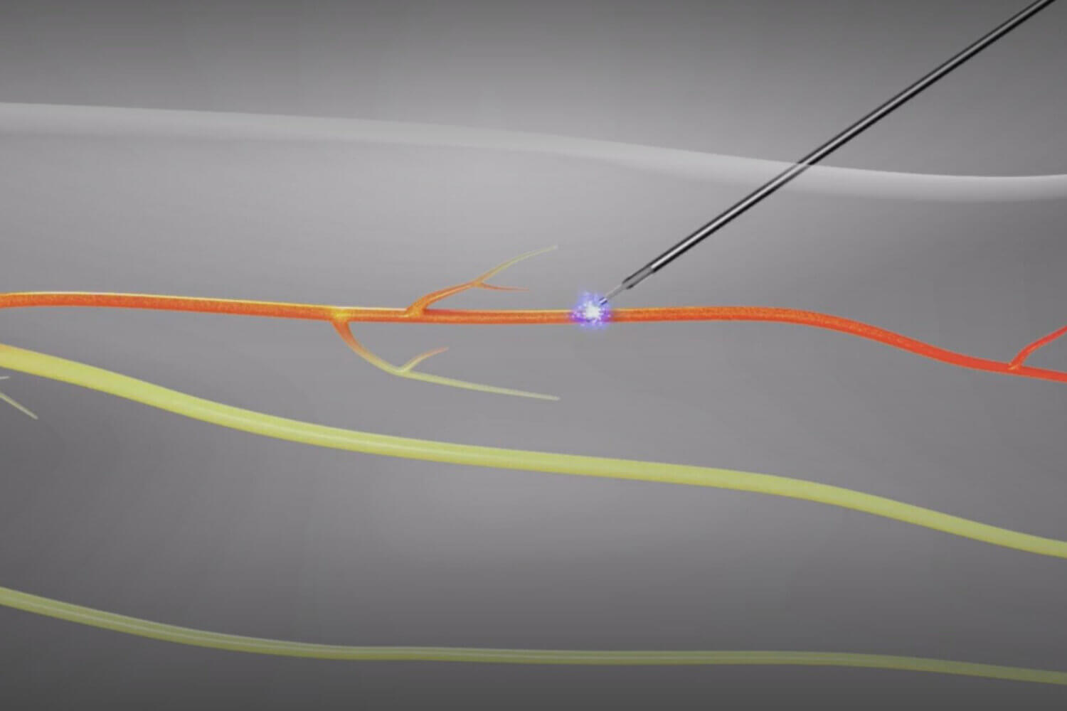Illustrated x-ray image of an ablation needle applying heat to a nerve