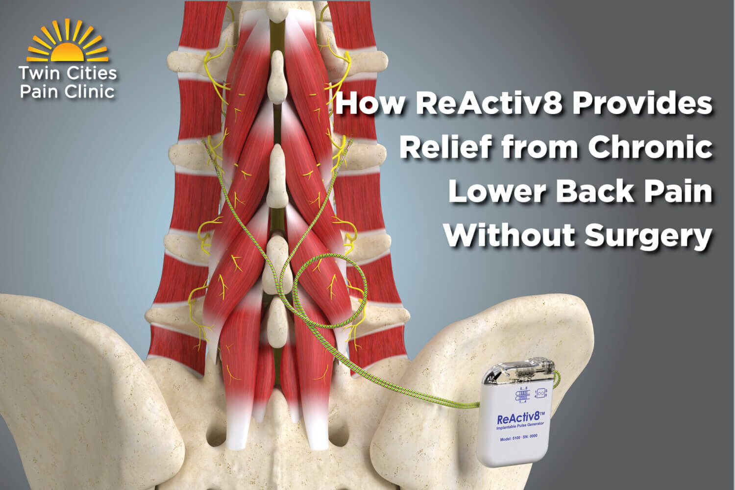 How ReActiv8 Provides Relief from Chronic Lower Back Pain Without Surgery
