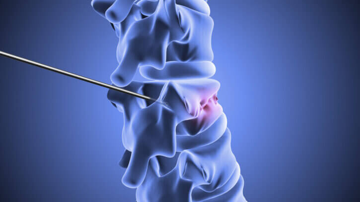 intracept procedure