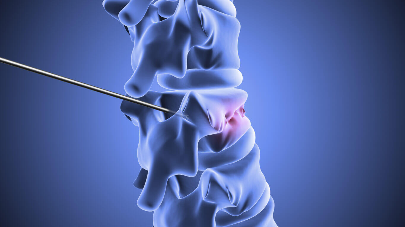 intracept procedure