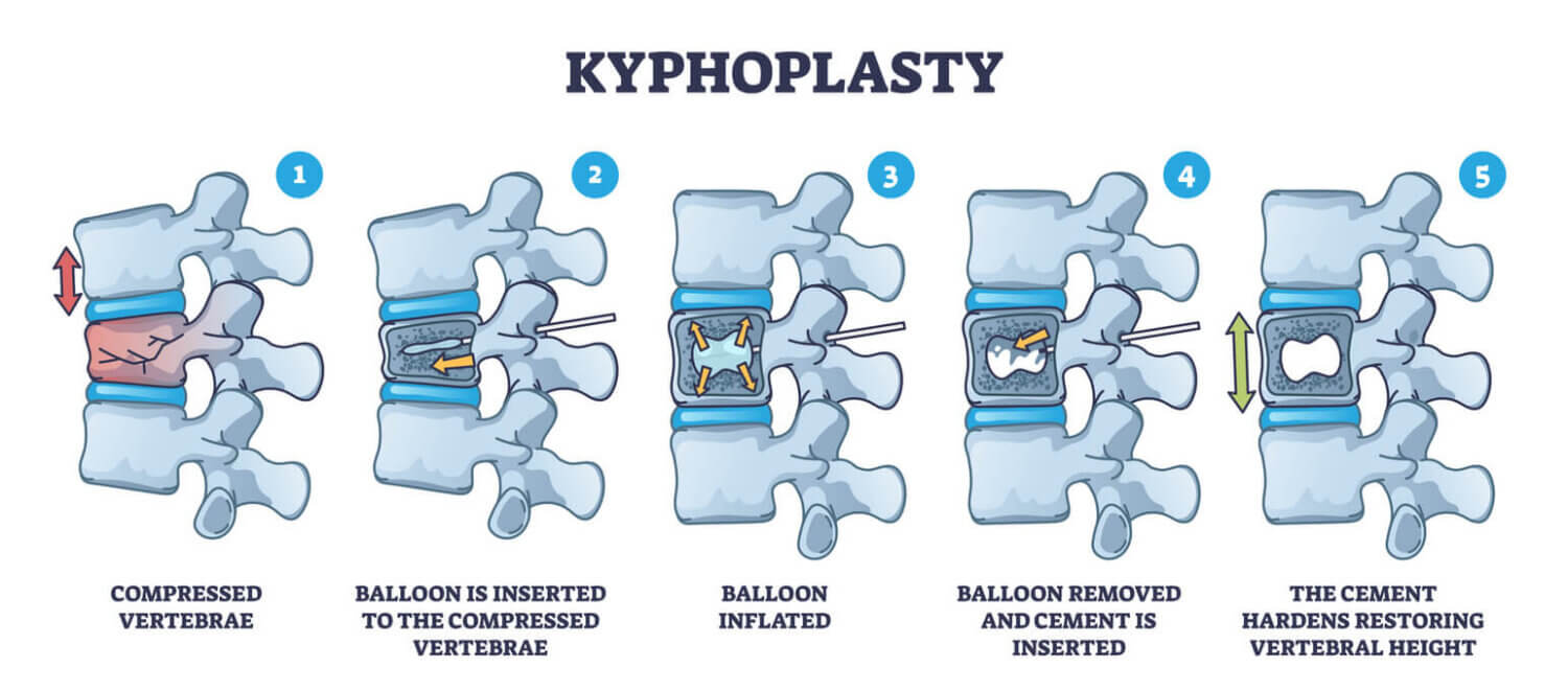 Step-by-step graphic of kyphoplasty procedure