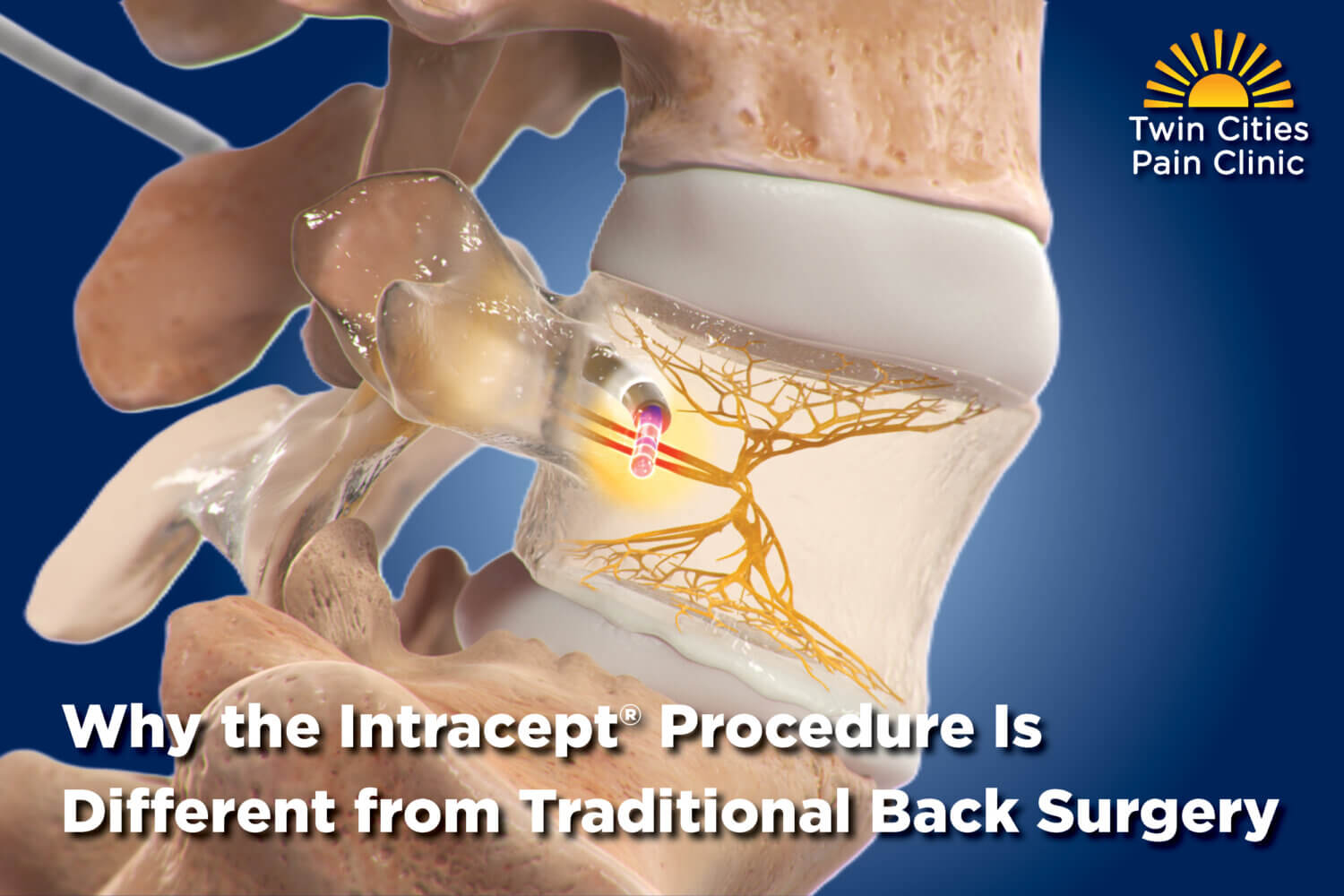 Why the Intracept® Procedure Is Different from Traditional Back Surgery